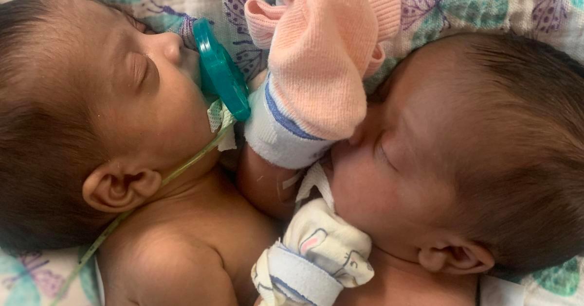 Conjoined twins successfully separated at Texas hospital